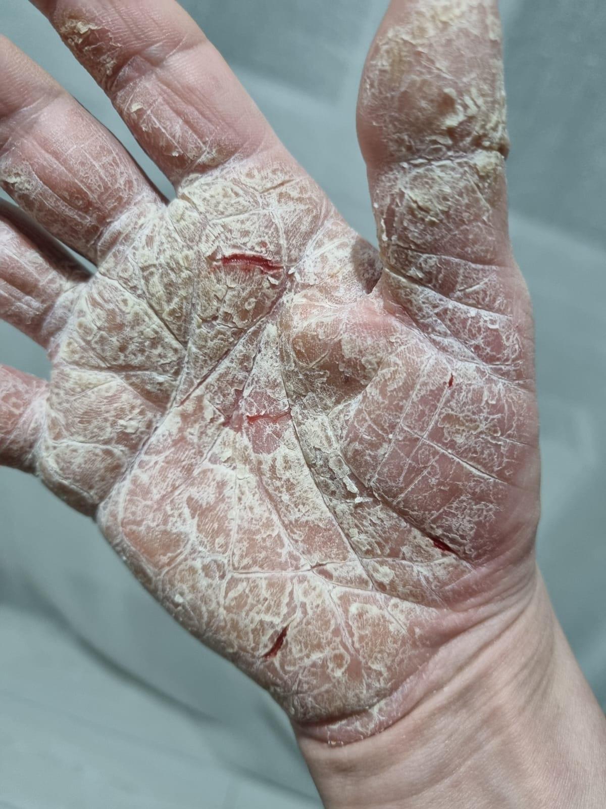 cham-day-sung.jpg Lòng bàn tay bị chàm dày sừng, da dày và nứt.