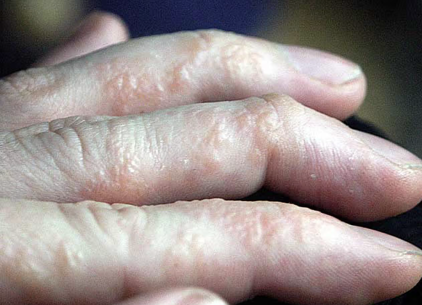cham-to-dia.png Bàn tay bị chàm tổ đỉa với nhiều mụn nước nhỏ, li ti.
