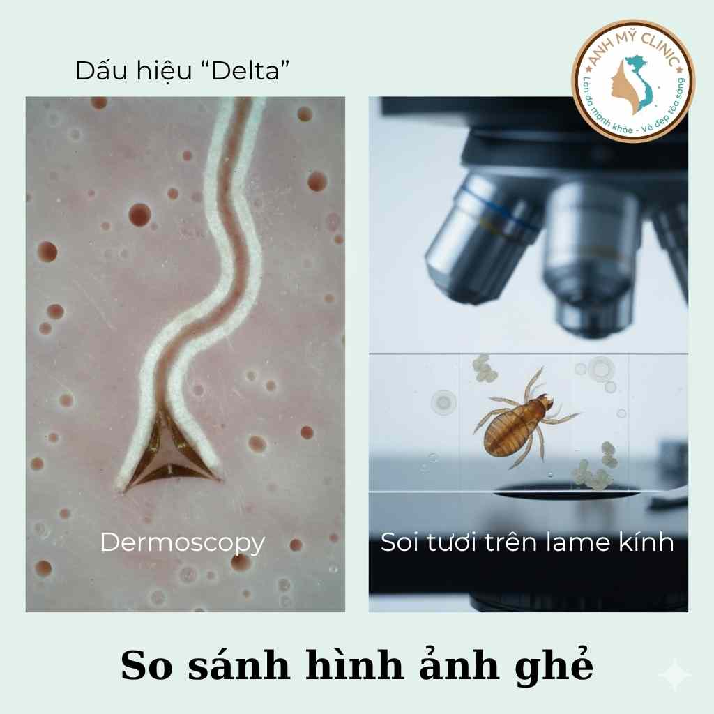 Soi da thấy dấu delta, cạo da soi k&iacute;nh x&aacute;c nhận bệnh ghẻ