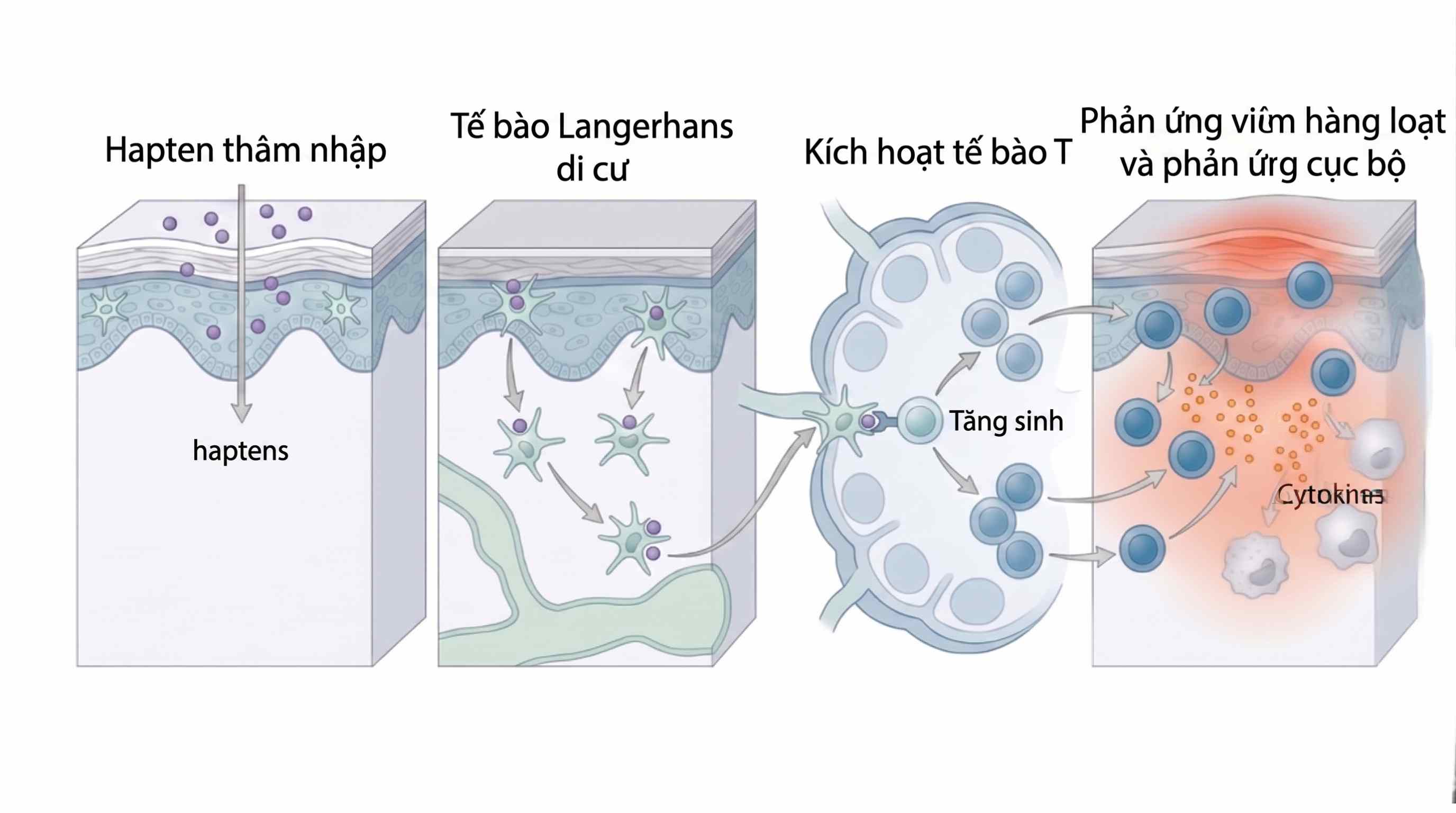 Sơ đồ cơ chế dị ứng tiếp x&uacute;c type IV v&ugrave;ng m&ocirc;i &ndash; vi&ecirc;m m&ocirc;i tiếp x&uacute;c dị ứng ACC