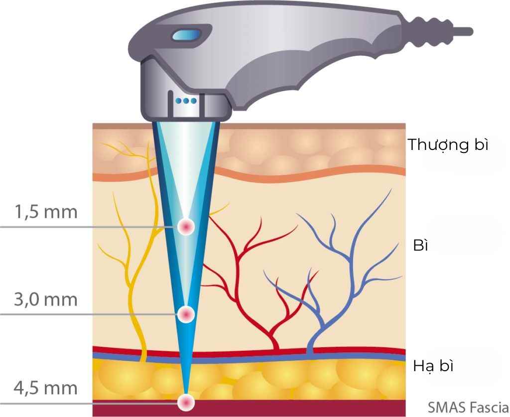 H&igrave;nh ảnh m&ocirc; tả cơ chế s&oacute;ng si&ecirc;u &acirc;m của c&ocirc;ng nghệ HIFU t&aacute;c động ch&iacute;nh x&aacute;c v&agrave;o lớp SMAS, gi&uacute;p n&acirc;ng cơ v&ugrave;ng mặt v&agrave; nọng cằm từ s&acirc;u b&ecirc;n trong.