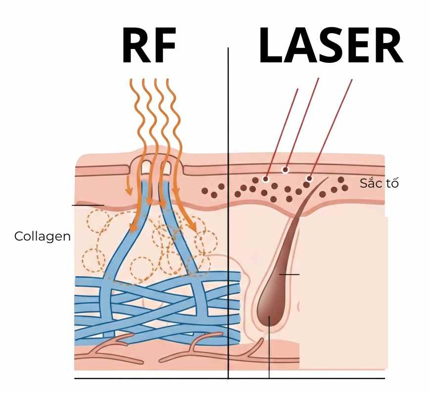  Sơ đồ so s&aacute;nh cơ chế t&aacute;c động của s&oacute;ng RF v&agrave; laser tr&ecirc;n da, l&agrave;m r&otilde; v&igrave; sao RF facial an to&agrave;n cho mọi t&ocirc;ng da.