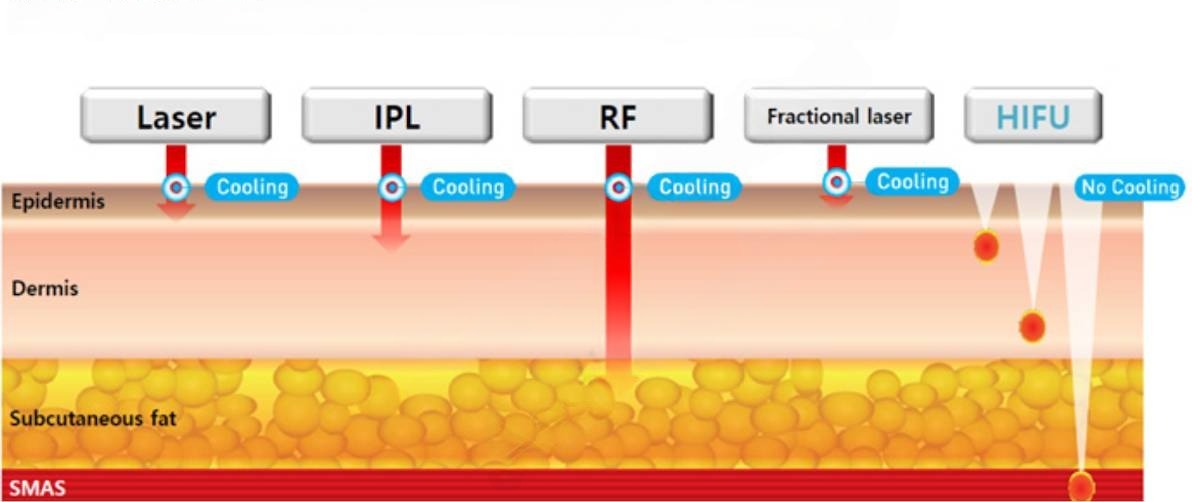 co-che-tre-hoa-da-mat-khong-xam-lan.jpg Sơ đồ các lớp da và cơ chế tác động của các công nghệ trẻ hóa da mặt không xâm lấn