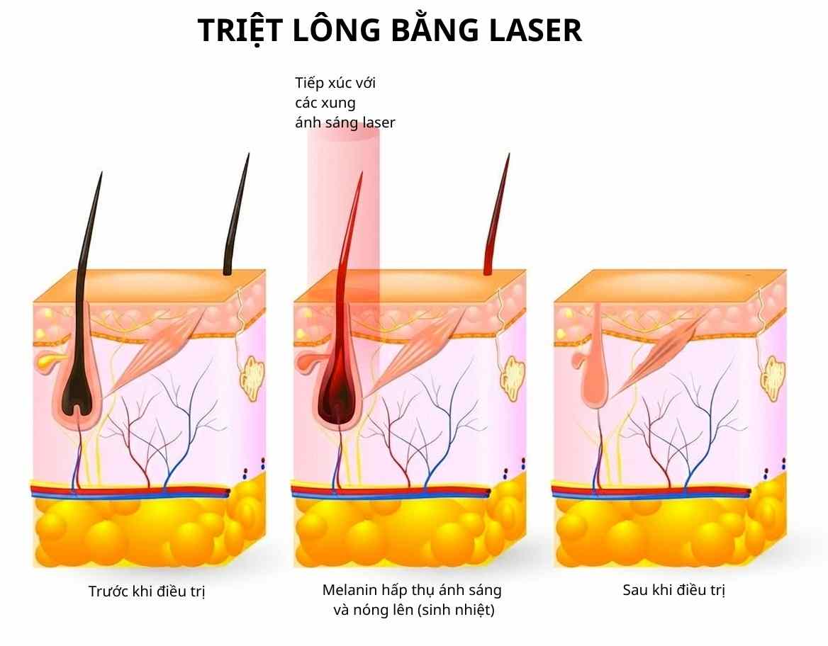 Mô phỏng cơ chế triệt lông bằng laser diode 808nm tác động nhiệt vào nang lông dưới da.