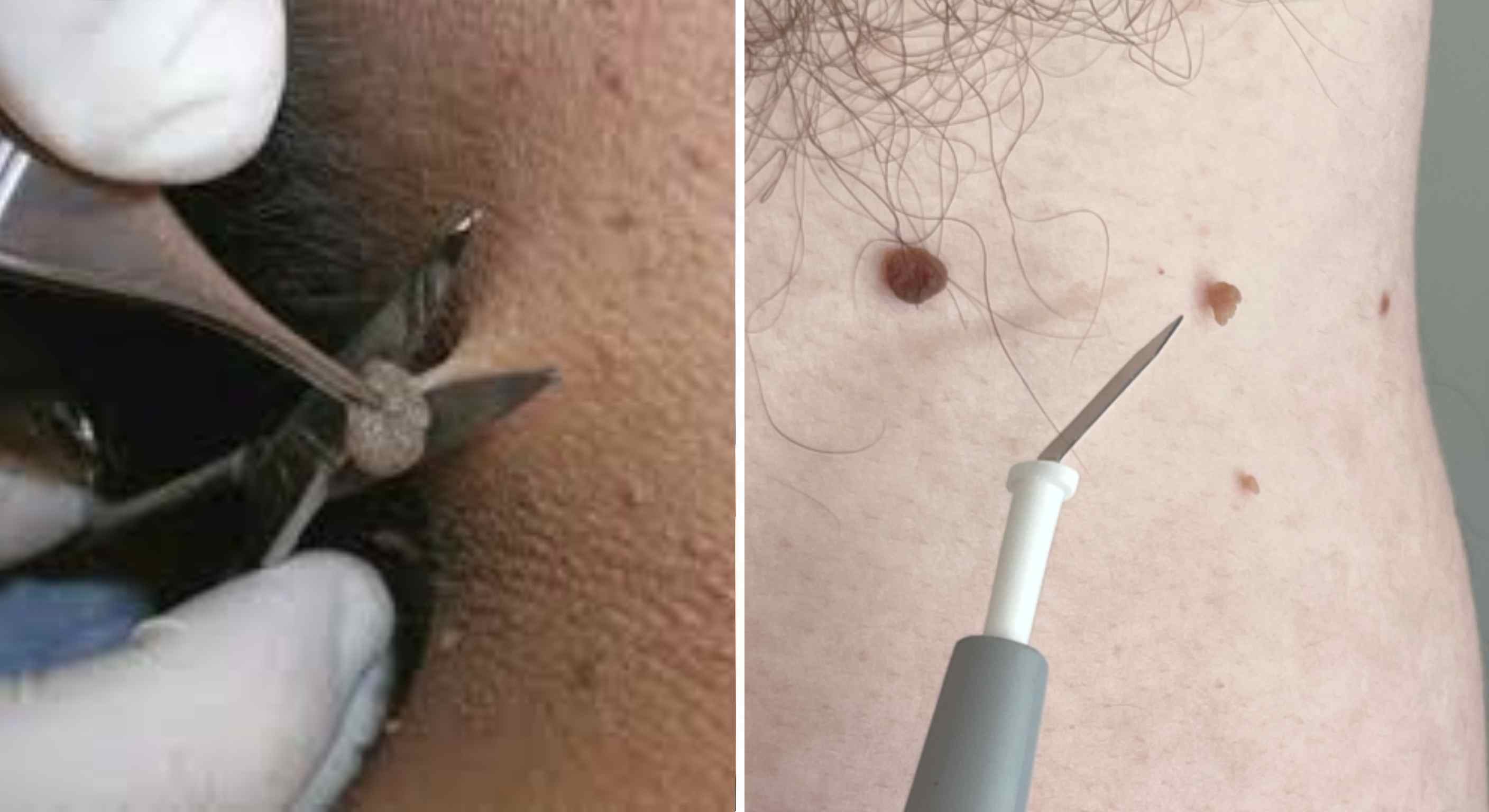 cong-nghe-dieu-tri-u-da-hien-dai-anh-my-clinic.jpg Phương pháp loại bỏ u mềm treo