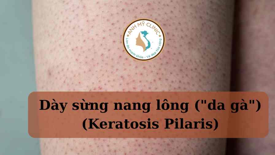 Bí Quyết Đánh Bay Da Gà - Khám Phá Giải Pháp Chăm Sóc Da Hiệu Quả!