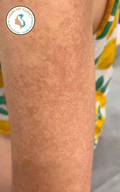 D&agrave;y sừng nang l&ocirc;ng k&egrave;m tăng sắc tố sau vi&ecirc;m