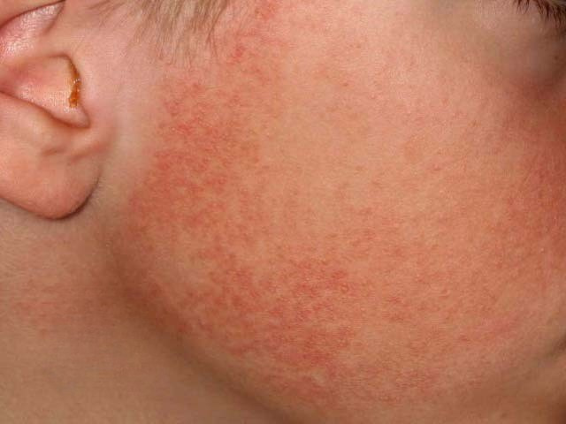 D&agrave;y sừng nang l&ocirc;ng teo da ở mặt