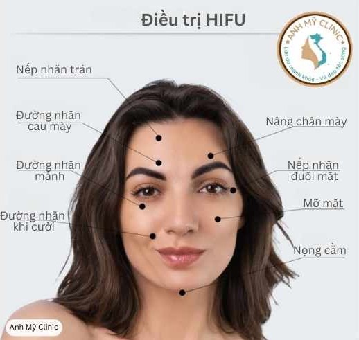 Điều trị HIFU