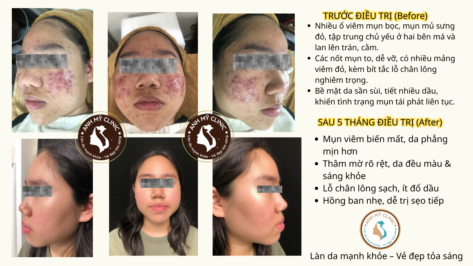 Hiệu quả điều trị mụn trứng c&aacute; nặng sau 5 th&aacute;ng