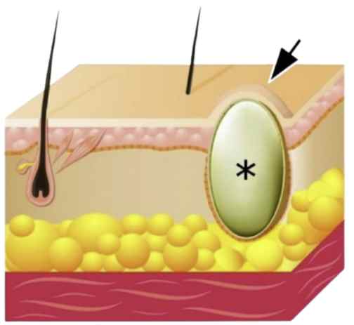 H&igrave;nh ảnh m&ocirc; tả cấu tr&uacute;c mặt cắt của một u nang biểu b&igrave;, một loại u l&agrave;nh da c&oacute; vỏ bao.