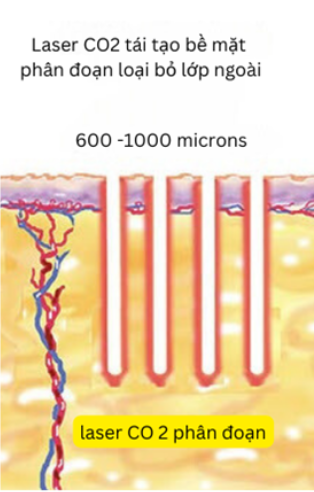 Laser CO2 Fractional 