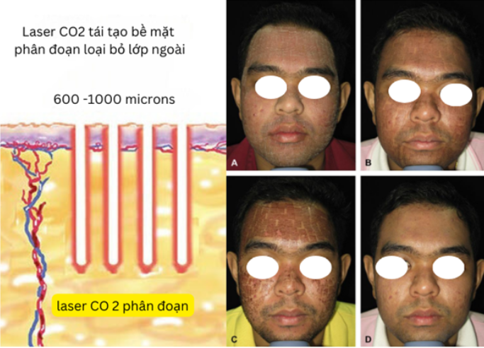 Laser CO2 phân đoạn tái tạo bề mặt