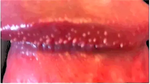 H&igrave;nh ảnh l&acirc;m s&agrave;ng gai sinh dục v&ugrave;ng quy đầu &mdash; cần ph&acirc;n biệt với s&ugrave;i m&agrave;o g&agrave; HPV qua thăm kh&aacute;m b&aacute;c sĩ da liễu