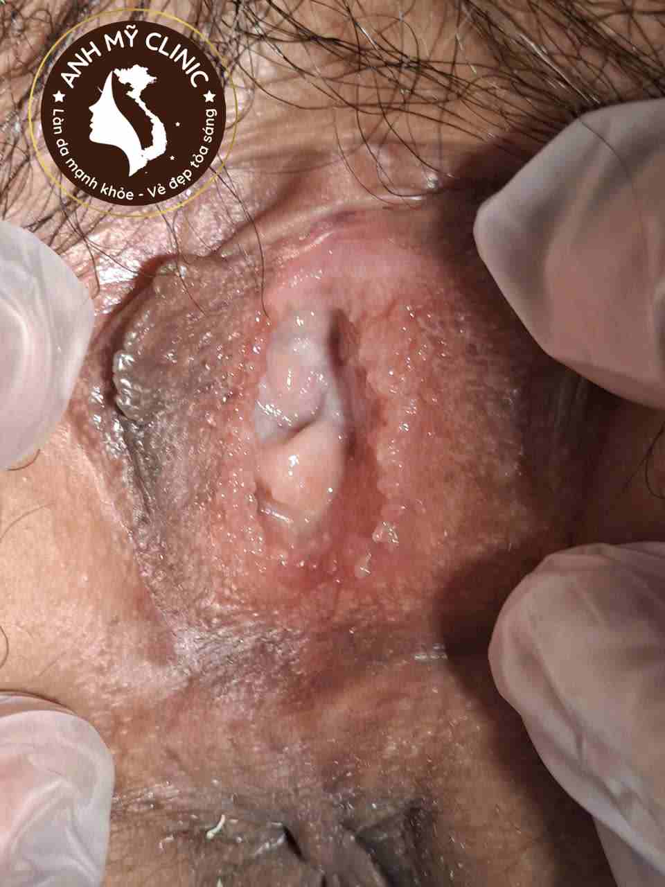 Nhiều nh&uacute; nhỏ đồng dạng ở v&ugrave;ng tiền đ&igrave;nh &acirc;m hộ, ph&ugrave; hợp gai sinh dục v&ugrave;ng tiền đ&igrave;nh l&agrave;nh t&iacute;nh