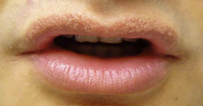 Đốm Fordyce là gì? Phân biệt với sùi mào gà | BS Trương Lê Đạo