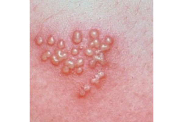 Hình ảnh lâm sàng của 2 thể loại Herpes Simplex loại 1 và loại 2: Những điều cần biết