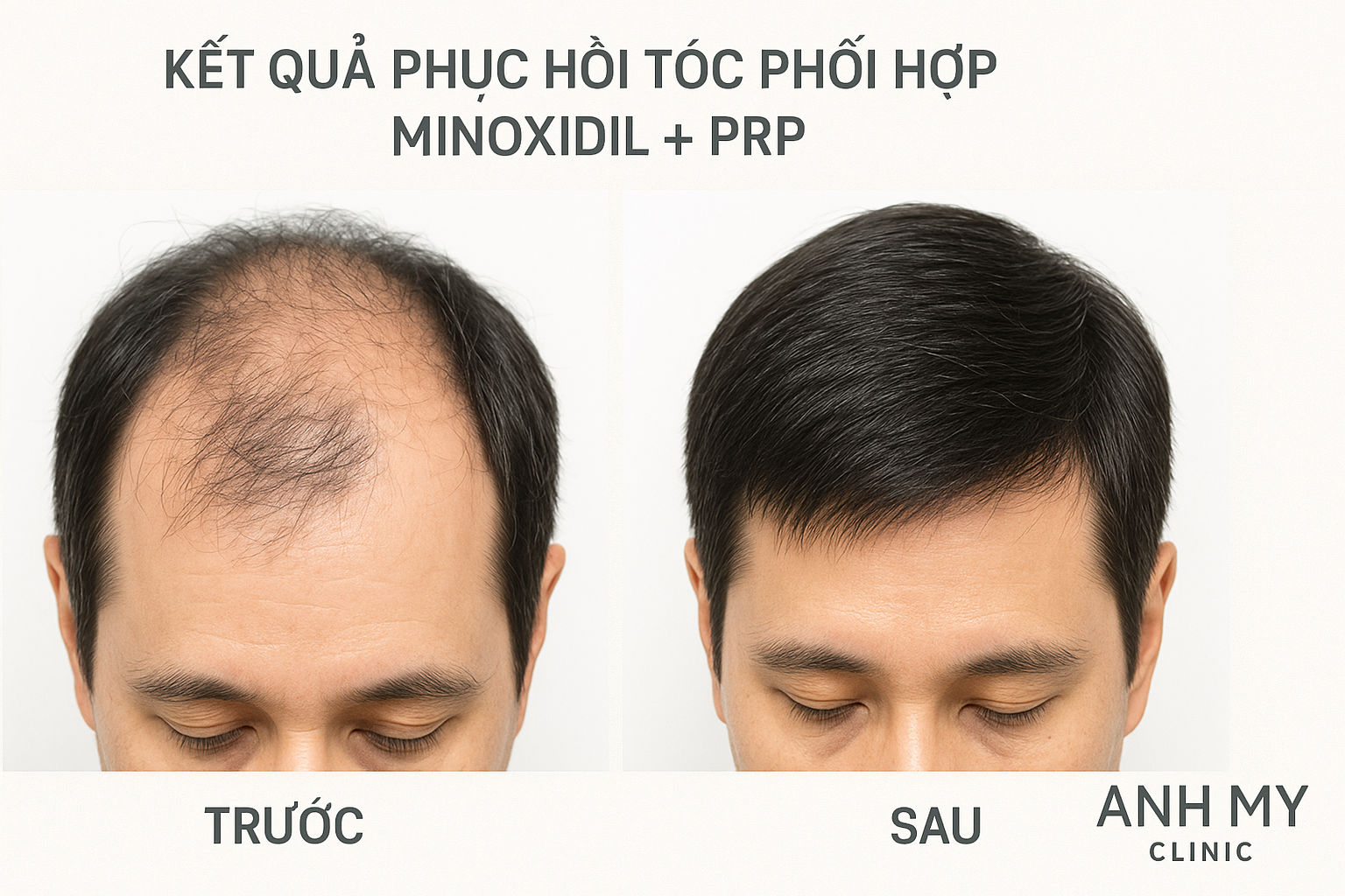  Ảnh trước v&agrave; sau điều trị kết hợp Minoxidil v&agrave; PRP cho bệnh nh&acirc;n rụng t&oacute;c tại Ph&ograve;ng Kh&aacute;m Da Liễu Anh Mỹ