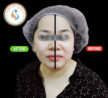 HIFU gi&uacute;p cải thiện nếp gấp mũi-m&aacute;, l&agrave;m đầy r&atilde;nh Marionette