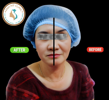 hifu-cai-thien-ranh-cuoi-va-marionette1.png HIFU giúp cải thiện nếp gấp mũi-má, làm đầy rãnh Marionette