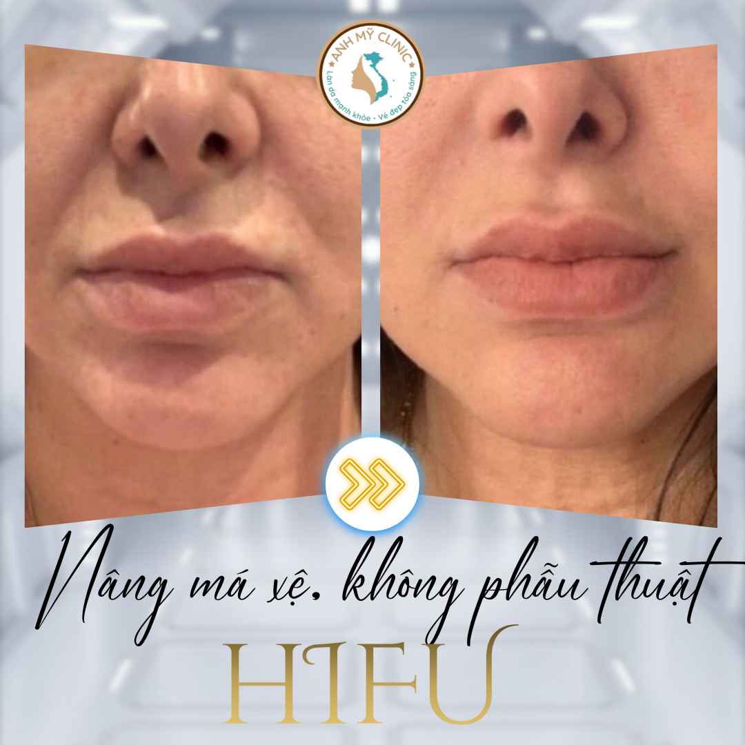 Hình Ảnh Trước Sau HIFU: Nâng Cơ, Trẻ Hóa Da Tại Anh Mỹ Clinic