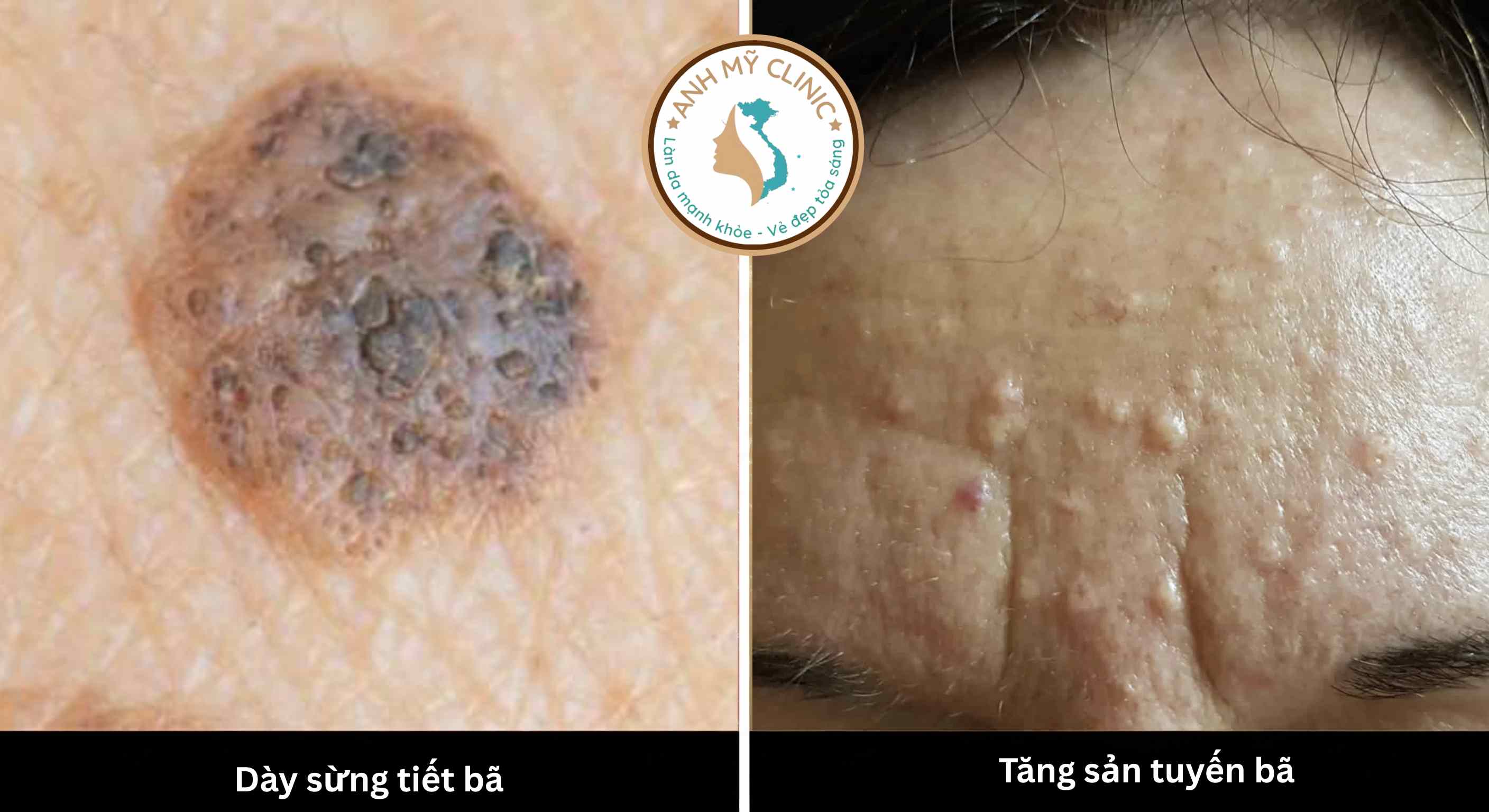 Soi da l&agrave; c&ocirc;ng cụ kh&ocirc;ng thể thiếu gi&uacute;p b&aacute;c sĩ ph&acirc;n biệt c&aacute;c tổn thương l&agrave;nh t&iacute;nh như d&agrave;y sừng tiết b&atilde; v&agrave; tăng sản tuyến b&atilde; với c&aacute;c dạng ung thư da. 