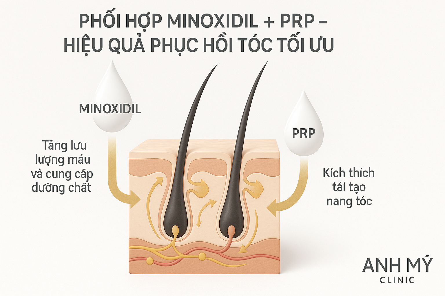 Sơ đồ m&ocirc; tả cơ chế bổ trợ giữa Minoxidil v&agrave; PRP gi&uacute;p tăng mật độ t&oacute;c nhanh ch&oacute;ng tại Anh Mỹ Clinic