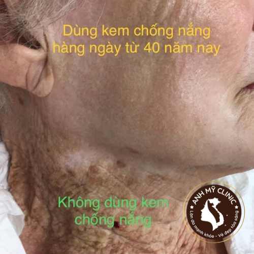 Lão hóa da do ánh sáng mặt trời