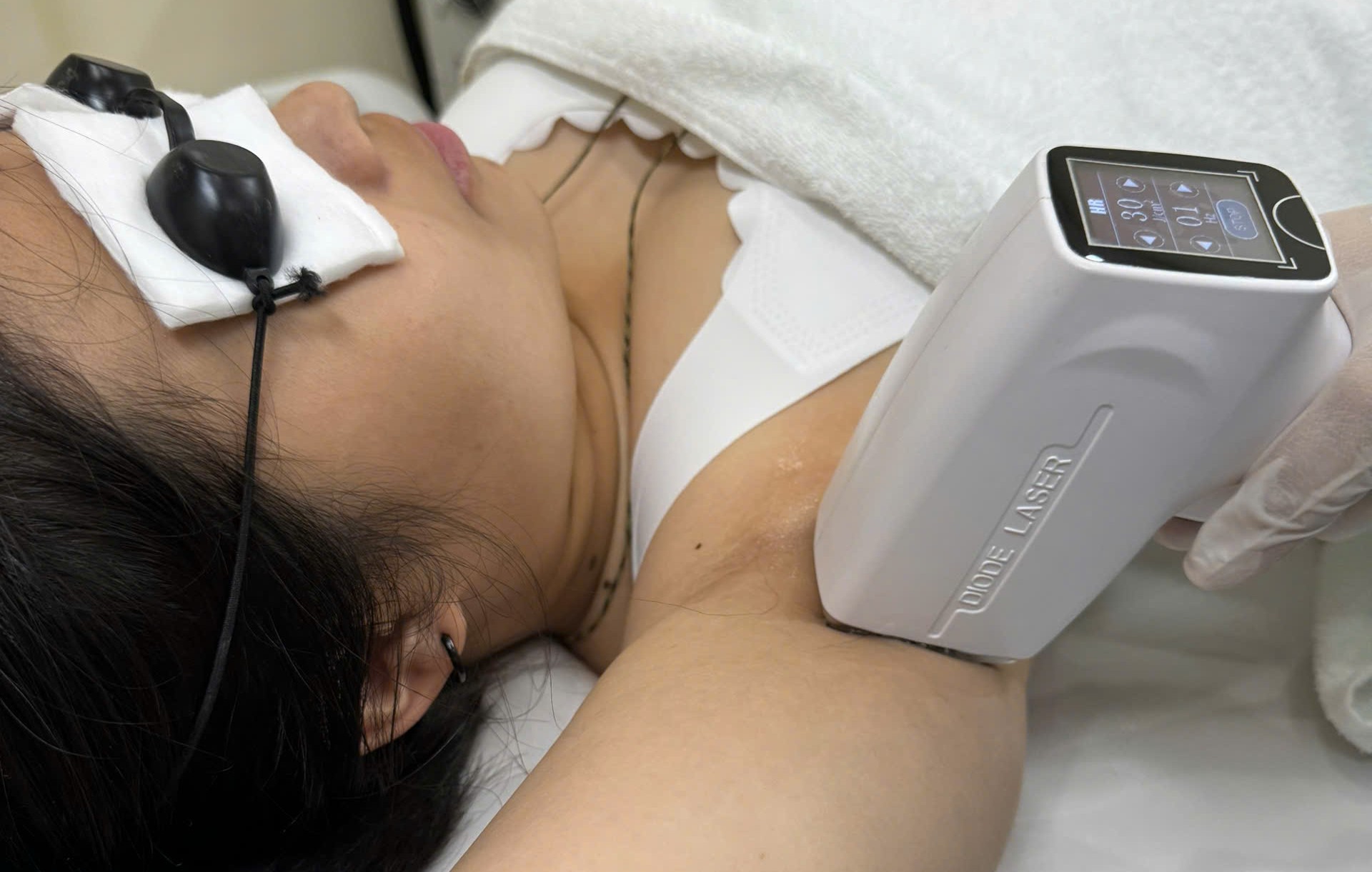 Laser diode triệt l&ocirc;ng n&aacute;ch