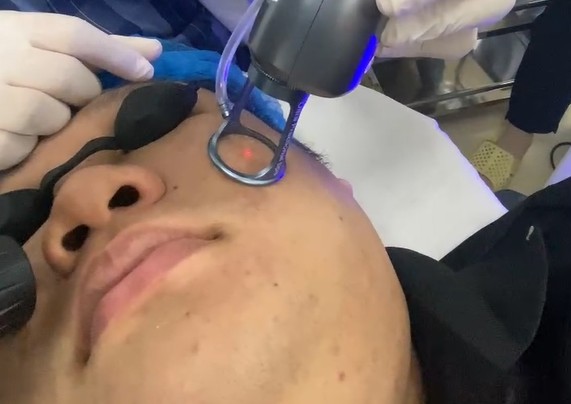 Laser Fractional CO 2