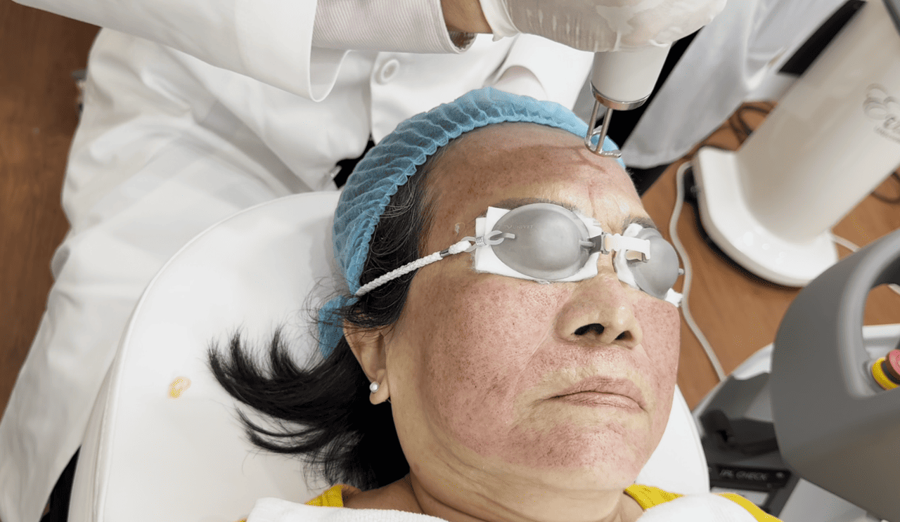 Laser Nd:Yag trẻ h&oacute;a da