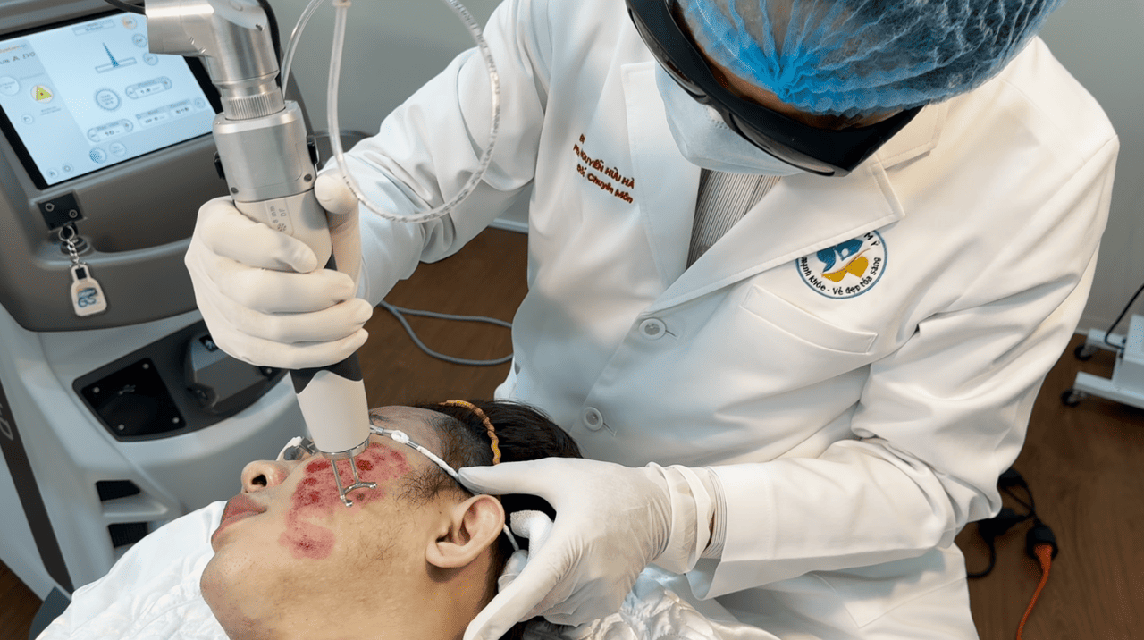 Laser Nd:Yag x&oacute;a sẹo rỗ