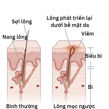 Lông bình thường và lông mọc ngược