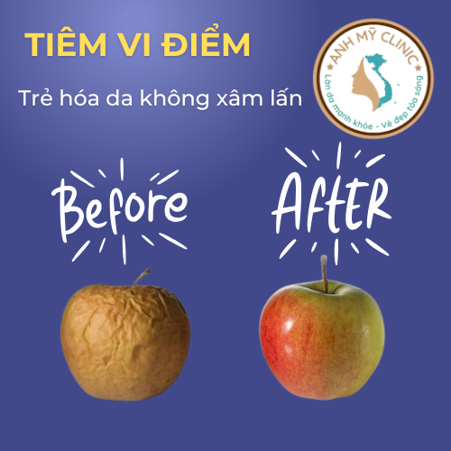 Tiêm Vi Điểm – Bí Quyết Trẻ Hóa Làn Da Tại Anh Mỹ Clinic