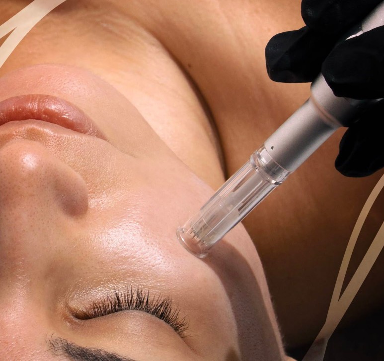 microneedling.jpg Microneedling