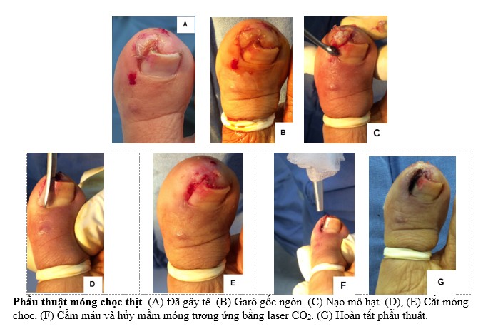  phẫu thuật điều trị m&oacute;ng chọc thịt bằng kỹ thuật partial avulsion &ndash; Ph&ograve;ng Kh&aacute;m Da Liễu Anh Mỹ.