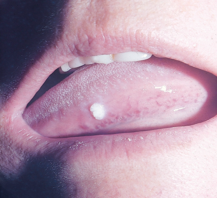 mong-ga-duoi-luoi.png Mồng gà dưới lưỡi