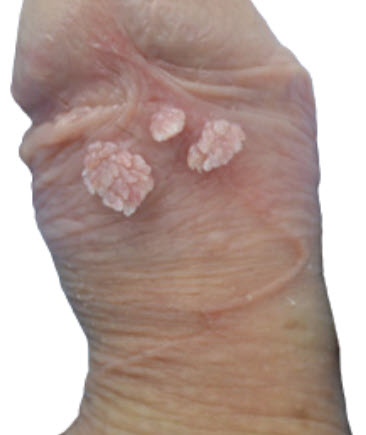 Mồng g&agrave; dương vật