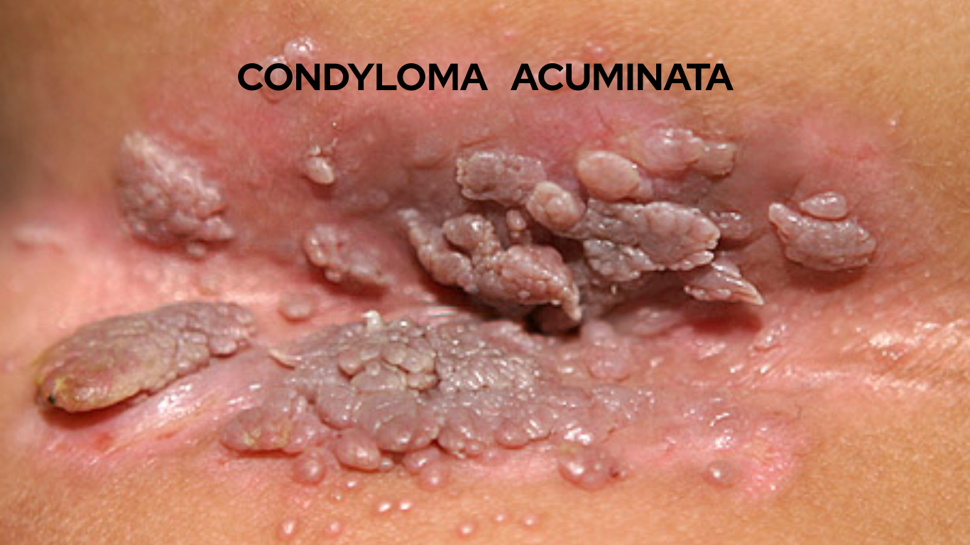 Bệnh Sùi Mào Gà: Hướng Dẫn Chẩn Đoán & Điều Trị Hiệu Quả 2024
