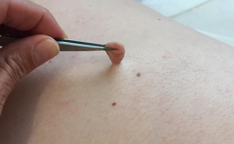 Khám Phá Tất Tần Tật về U Mềm Treo (Skin Tags): Nguyên Nhân và Cách Điều Trị An Toàn