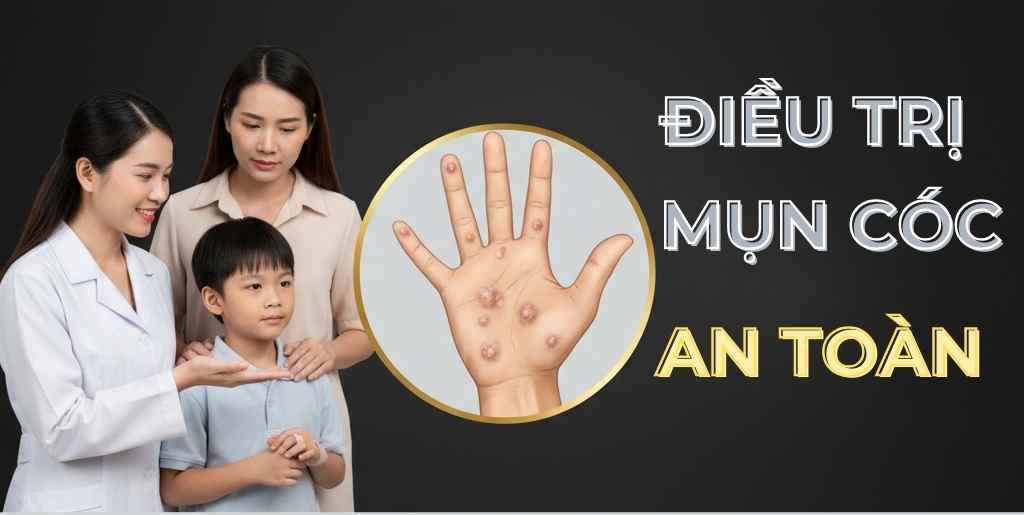 Mụn cóc trẻ em và người lớn: Nguyên nhân, cách xử lý an toàn
