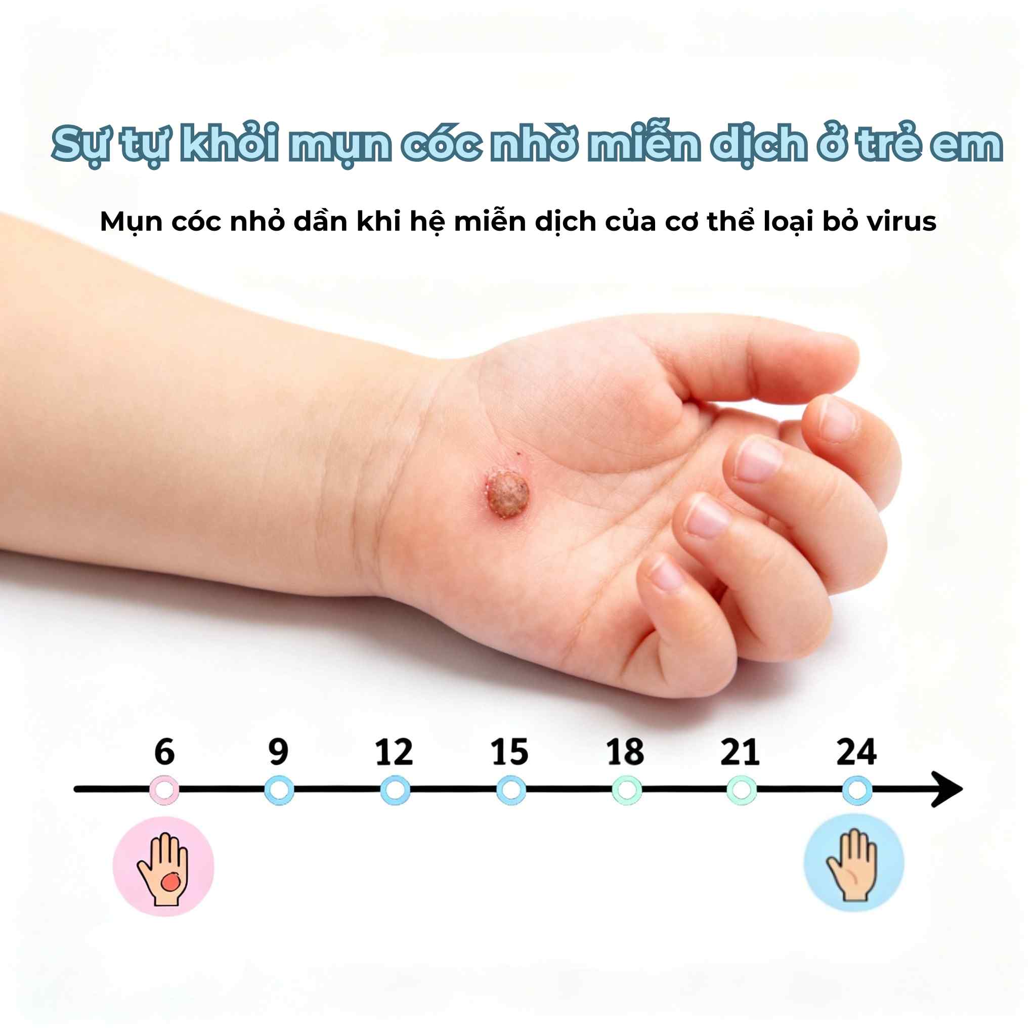 Minh họa tiến tr&igrave;nh mụn c&oacute;c ở trẻ em tự biến mất nhờ hệ miễn dịch trong v&ograve;ng 6&ndash;24 th&aacute;ng
