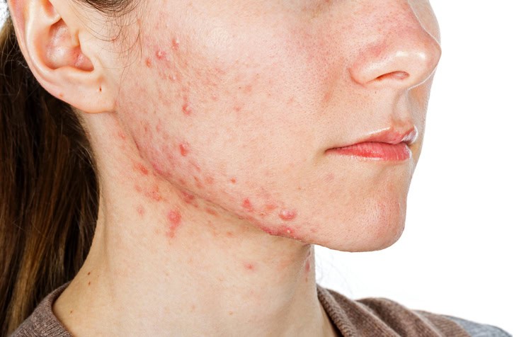 mun-noi-tiet.jpg?v=1 Mụn Nội Tiết