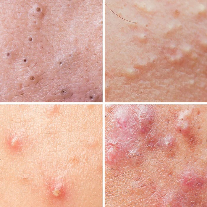 cac-loai-mun-trung-ca.jpg Các loại mụn trứng cá