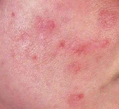 mun-trung-ca-cao-xuoc1.jpg Mụn Trứng Cá Cào Xước