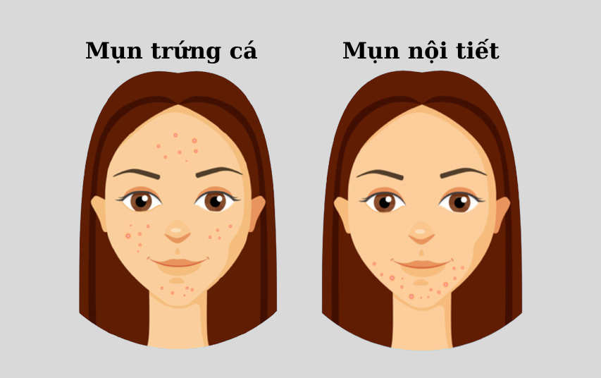 mun-trung-ca-vs-mun-noi-tiet.png Mụn trứng cá so với mụn nội tiết