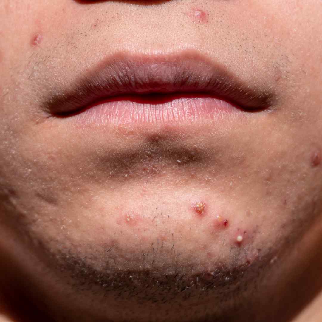 Điều trị mụn trứng cá hiệu quả cùng bác sĩ – Phòng Khám Da Liễu Anh Mỹ