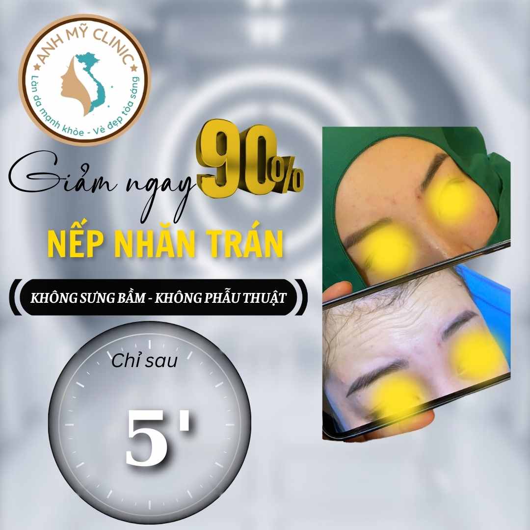 Xóa nếp nhăn trán