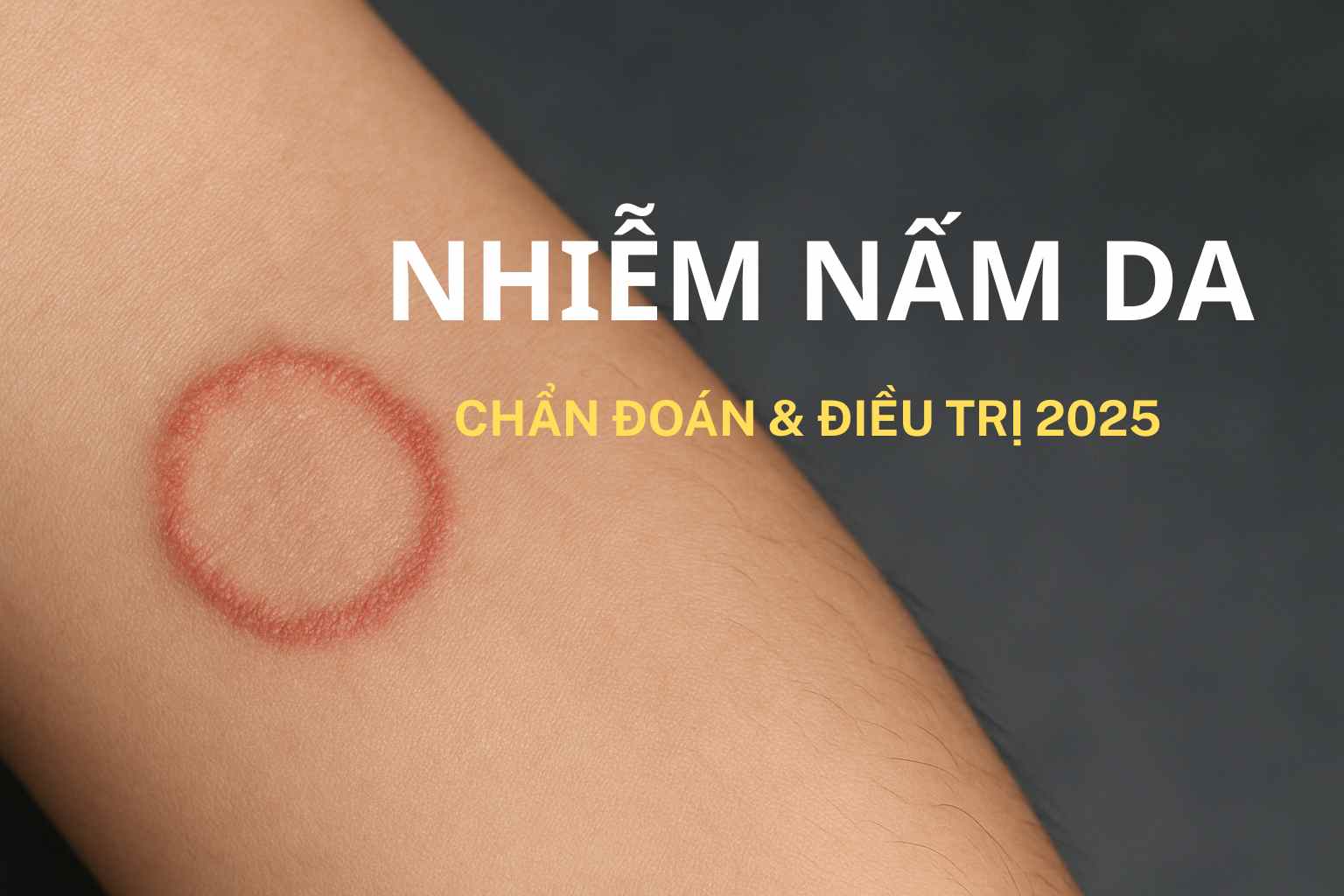 Nhiễm nấm da: Chẩn đoán & điều trị – BS Trương Lê Đạo