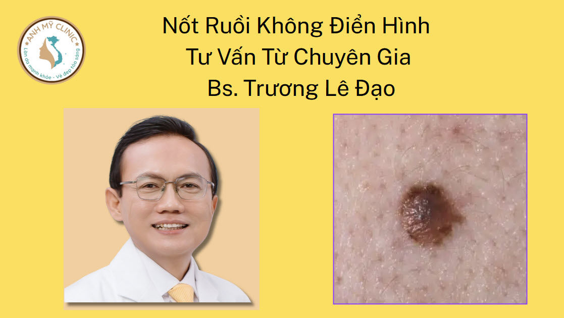 Nốt Ruồi Không Điển Hình | Tư Vấn Từ Chuyên Gia Bs. Trương Lê Đạo